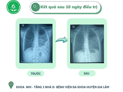 KẾT QUẢ NGOẠN MỤC SAU 10 NGÀY ĐIỀU TRỊ TRÀN DỊCH MÀNG PHỔI - VIÊM PHỔI NẶNG DO MYCOPLASMA TẠI KHOA NHI- BỆNH VIỆN HUYỆN GIA LÂM